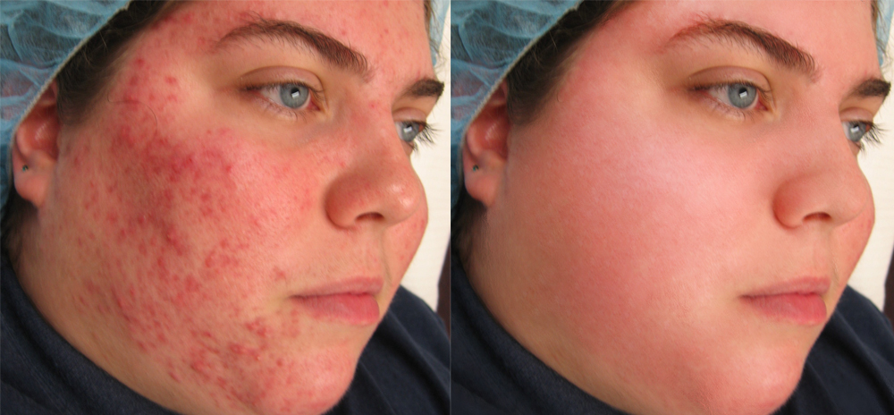 удаление прыщей