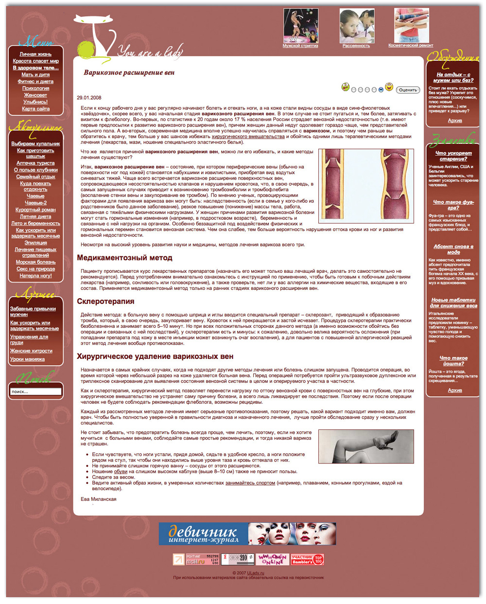 Варикозное расширение вен