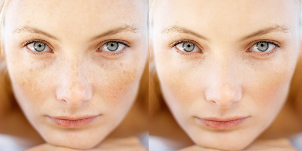 удаление веснушек