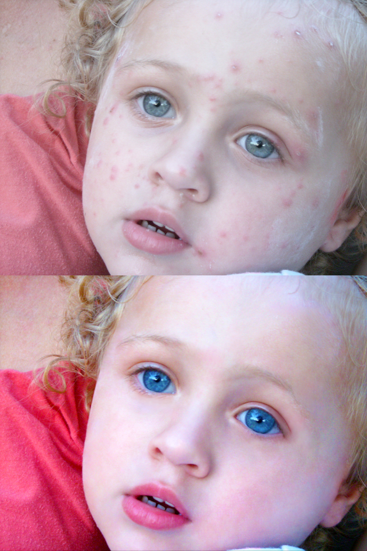 Ребенок - удаление ветрянки